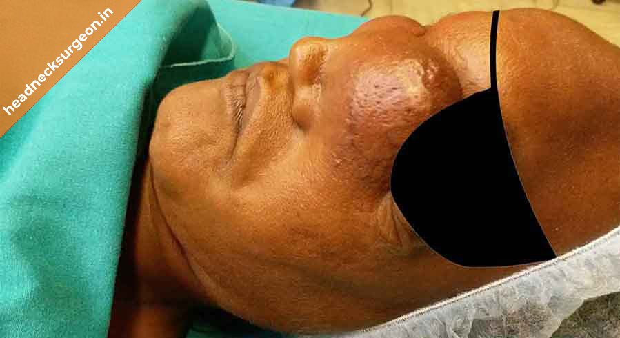 skull-base-cancer