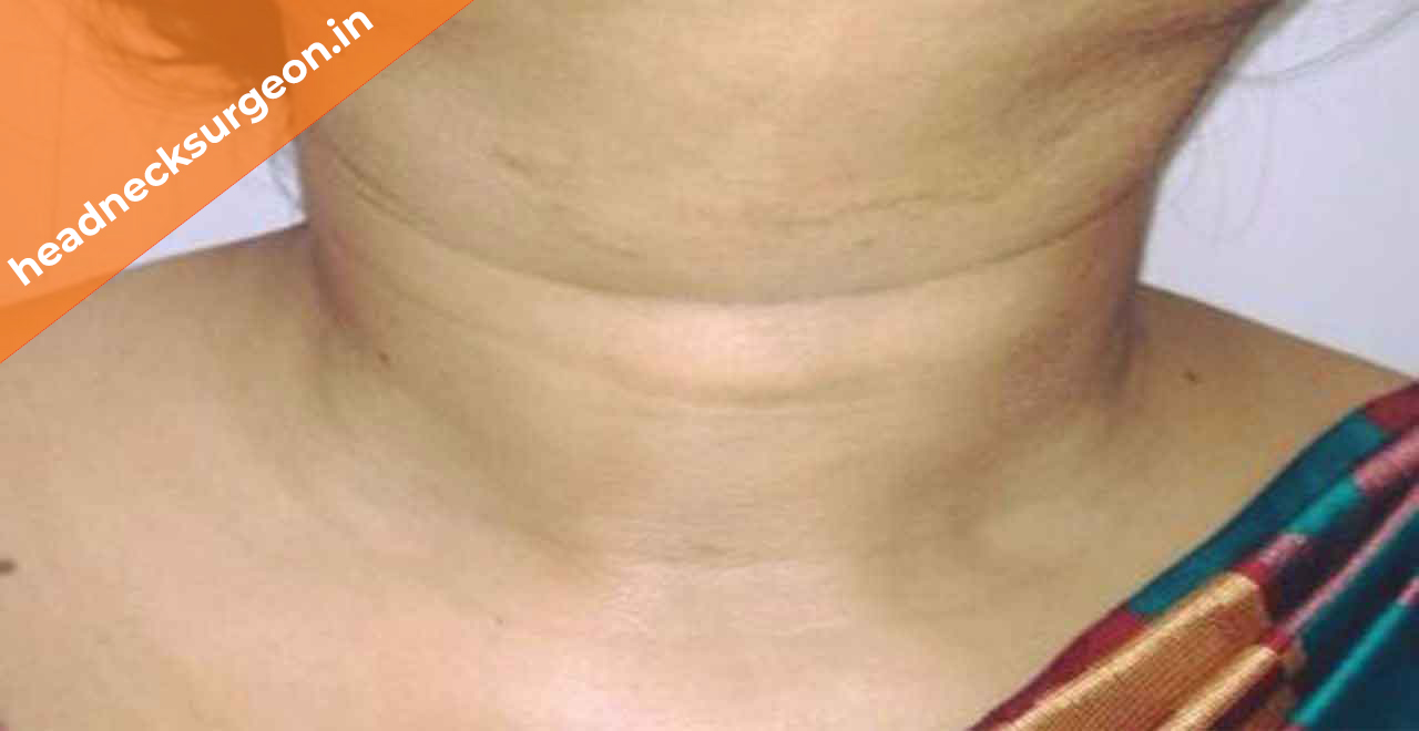 thyroid-cancer1